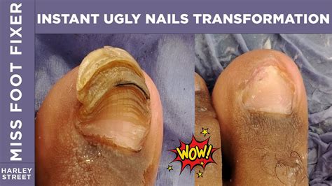INSTANT UGLY NAIL Transformation By Miss Foot Fixer Marion Yau - YouTube
