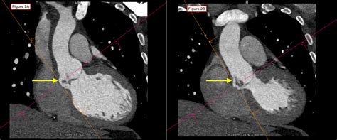 Cardiac Ct Scan Image Showing The Mass Around The Aortic Root And Images