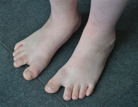 Filefeet Of A Boy With Down Syndrome Wikimedia Commons