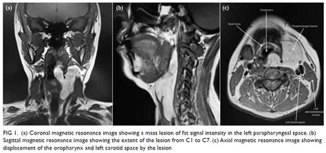 Parapharyngeal Space Lipoma A Case Report Hkmj