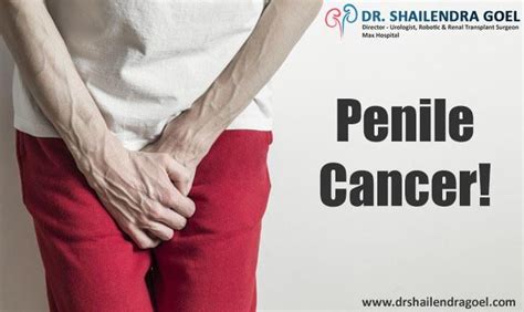 Penile Cancer Know The Causes Symptoms And Treatments U
