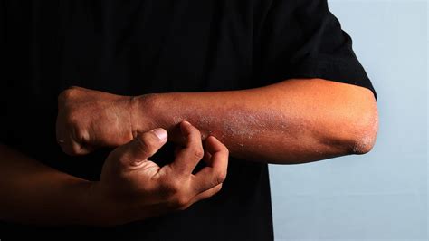 Clinical Challenges Managing Atopic Dermatitis In African Americans
