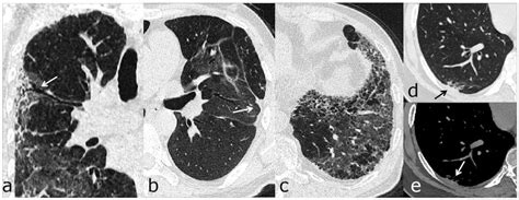 Ct Shows Lung Damage Six Months After Covid 19 Recovery Scan For Life