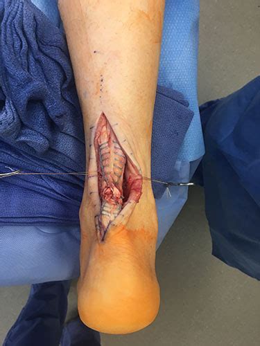 3:05 illinois bone & joint institute 22. Achilles Tendon Surgery | Southern California Foot & Ankle ...