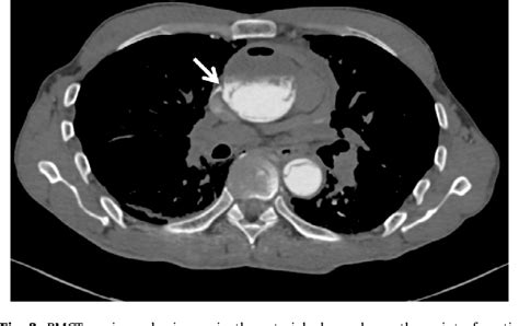 Figure 2 From The Role Of Post Mortem Ct Pmct Imaging In The