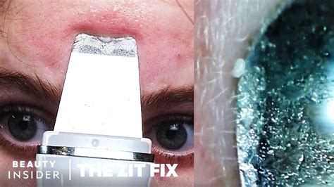 Pore Spatula Blackhead Extractions Under A Microscope The Zit Fix