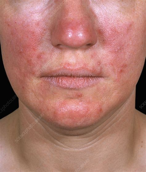 Acne Rosacea Stock Image C0494534 Science Photo Library