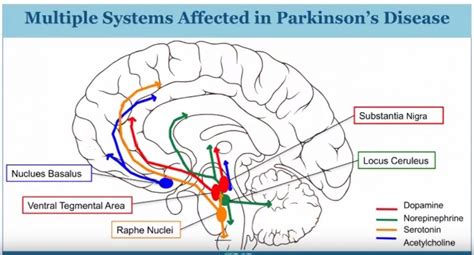 Parkinson's disease (pd) is a common neurodegenerative condition that usually presents with symptoms related to asymmetric bradykinesia, resting tremor, rigidity and postural instability. 1. What Is Parkinson's Disease - Rocky Mountain Movement Disorders Center