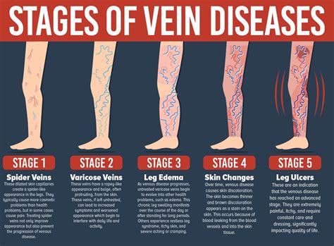 Dont Let Varicose Veins Get You Down Treatment Is Available Dr Michael Kerin Blog