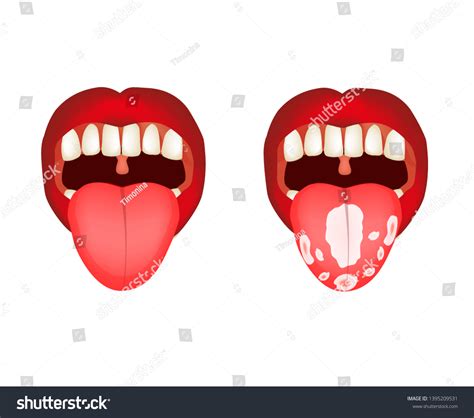 Candidiasis Tongue Thrush Inflammation Tongue Infographics Ilustrações