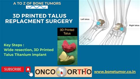 3d Printed Talus Implant Replacement Surgery Surgical Steps Youtube