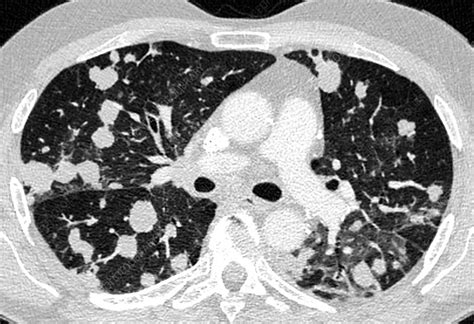 Secondary Lung Cancer Ct Scan Stock Image C0402213 Science