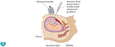 Here's what you need to know about amniocentesis and how to determine whether it's right for you. Mercy Perinatal