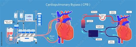 Cardiopulmonary Bypass Heart Lung Machine Coronary Oxygenator