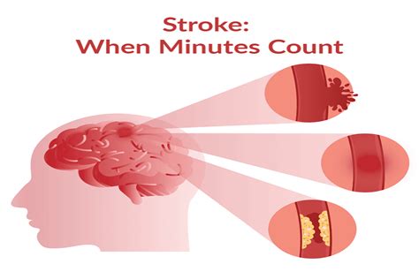 Stroke Causes Symptoms And Treatment