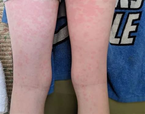 Mums Warning As Son Gets Worst Case Of Measles Ive Ever Seen Despite Having Two Mmr Jabs
