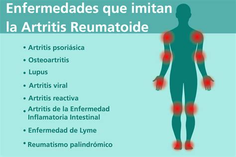 Artritis Reumatoide Vs Artrosis Actualizado Enero