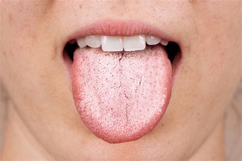 How Many Of You Have A White Coated Tongue Rbrainfog