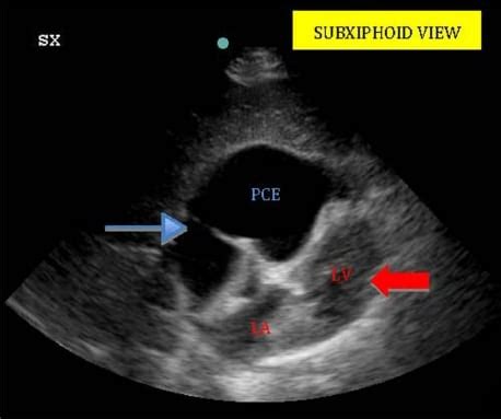 Mar 31, 2020 · better treatment options for metastatic cancer as well as prompt treatment of a developing pericardial effusion are critical to improve survival. Cardiac Tamponade after Minimally Invasive Coronary Artery ...
