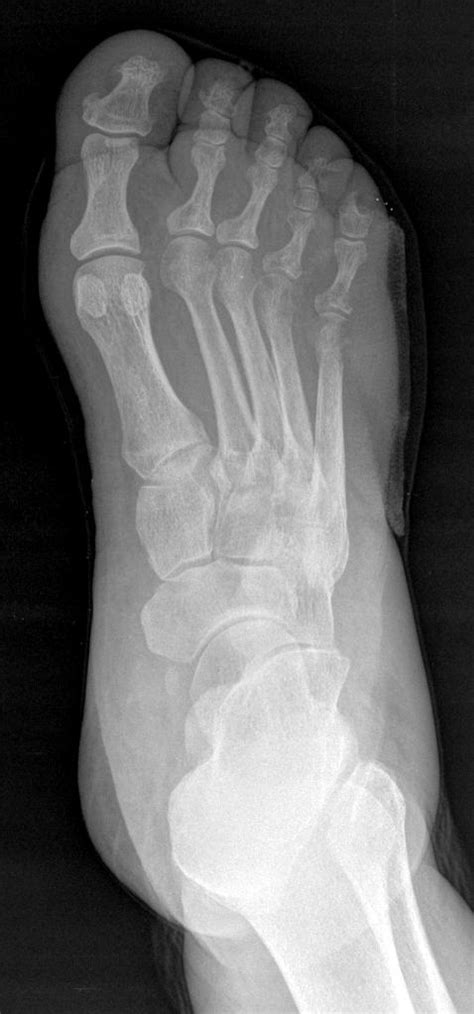 59 Year Old Diabetic With Pain And Swelling In Foot Journal Of Urgent