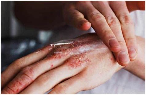 Scabies Vs Eczema Your Health Remedy