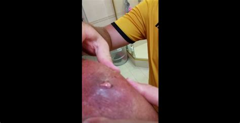 You can see the raised red spots on such areas where one or more of your hair grows inside your skin. Draining of an infected ingrown hair