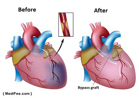 Heart Bypass Surgery Methods Recovery Time And Risks