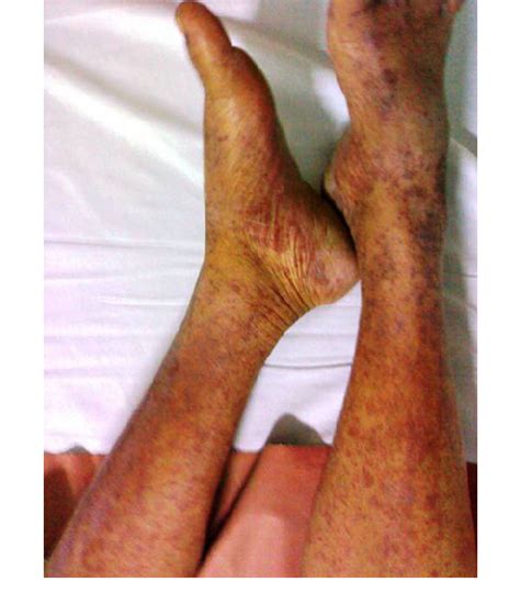 Erythematous Maculopapular Rash With Vasculitis Lesions Download