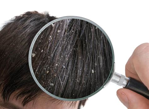 فرق شوره و پوسته سر چیست درمان قطعی شوره سر کلینیک پوست پدیا
