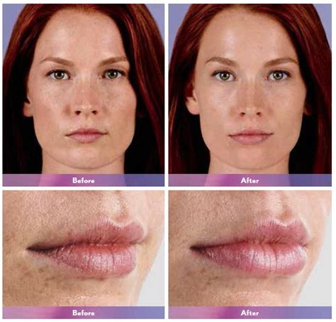Secret Weapon To Fighting Signs Of Aging Dermal Fillers Dy Dermatology