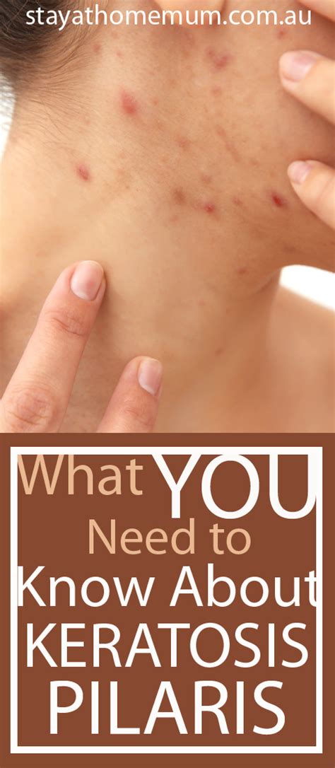 What You Need To Know About Keratosis Pilaris