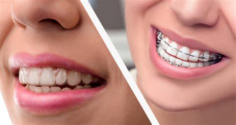 How Long Do You Have To Wear Invisalign Braces Barrhaven Orthodontic