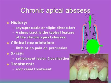 Periradicular Periapical Diseases Introduction U Periradicular Tissues