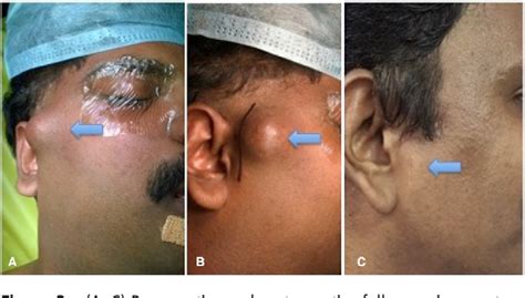 Figure 1 From Post Traumatic Preauricular Pulsatile Swelling In A