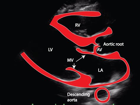 Discovering The Aorta Through Ultrasound Critical Care Sonography