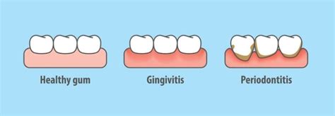 Six Signs Of Unhealthy Gum My Dentist Burbank