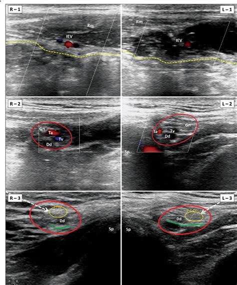 Figure 1 From Ultrasound Guided Pulsed Radiofrequency Ablation Of The