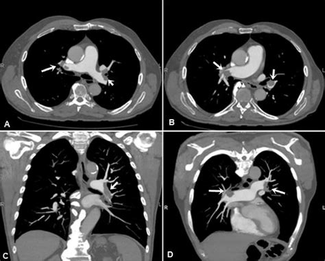 TROMBOEMBOLISMO PULMONAR TEP Y SUS COMPLICACIONES Seram