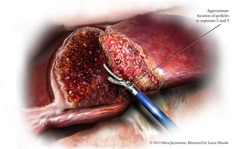Liver Sectionectomy Illustrations And Medical Surgical Illustrations