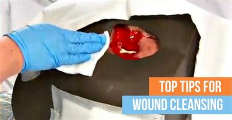 Top Tips For Best Wound Cleansing Practices Wcei