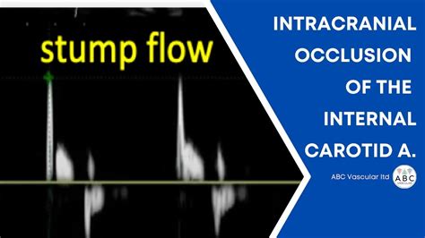 Intracranial Occlusion Of The Internal Carotid Artery Ultrasound