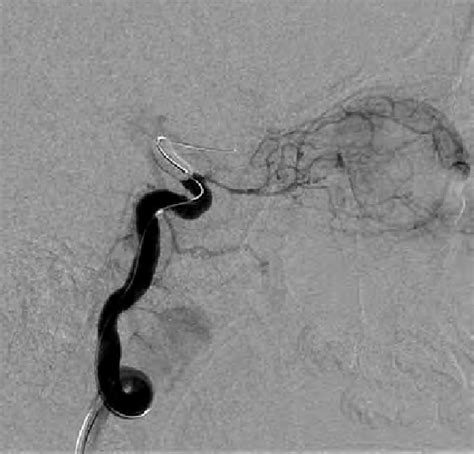 Selective Angiography Of The Right Ocular Artery After Catheterization