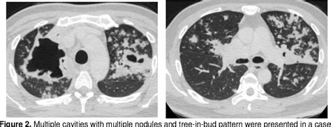 Figure 2 From Pulmonary Tuberculosis Ct Scan Features And Sputum Smear