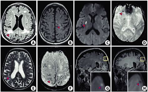 Imaging Features Of Cerebral Small Vessel Disease Biomarkers On