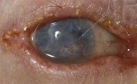 Dry Eye An Insight Into Meibomian Gland Dysfunction Intechopen My Xxx