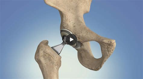 Osteoarthritis Hip Replacement