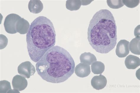 Acute Monoblastic Leukemia With Monoblasts Eccles Health Sciences