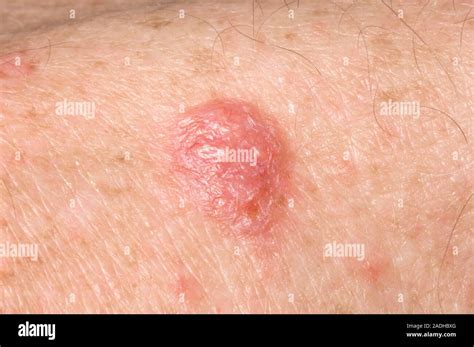 Basal Cell Carcinoma Bcc Or Rodent Ulcer On A 61 Year Old Mans