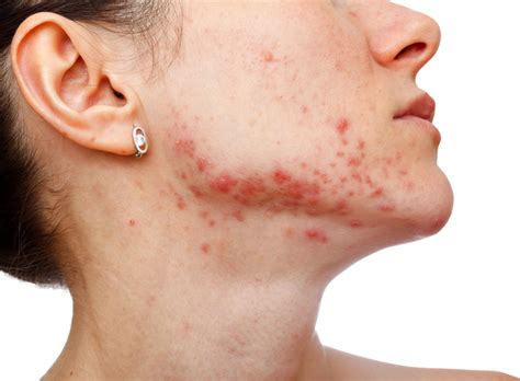 3 Tips You Need To Know To Manage Acne Thats Caused By Pcos Salubre