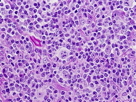 Hodgkins Lymphoma Pathology Outlines Beginmerchant